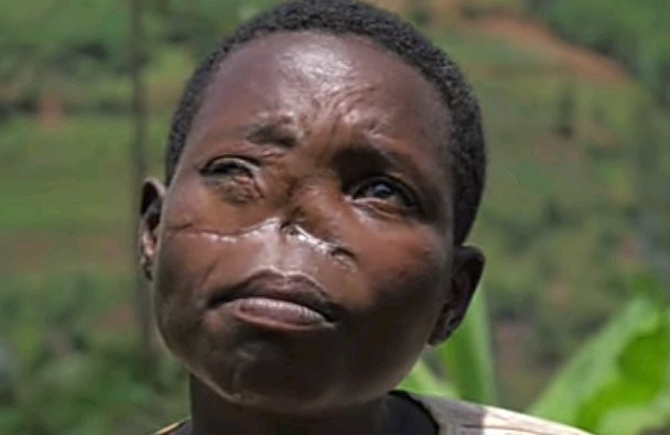 “I Lost My Nose To Gun Shot” A Woman Emotionally Narrates Photo Courtesy